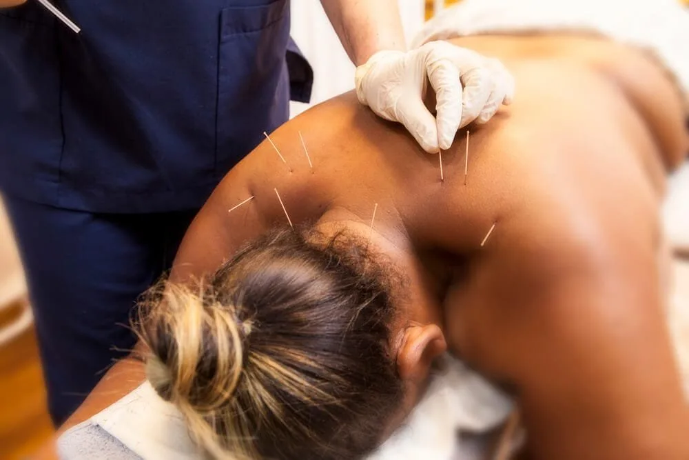 Dry Needling