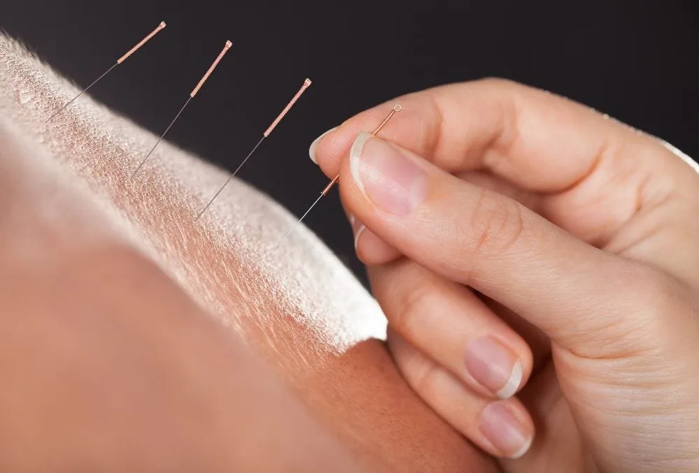 Acupuncture