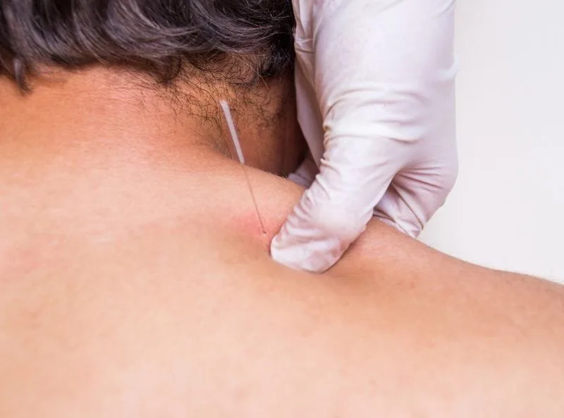 Dry Needling Therapy: A Natural Way to Relieve Muscle Pain