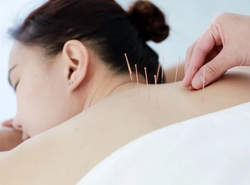 Expert Acupuncture Services for Natural Pain Relief and Healing